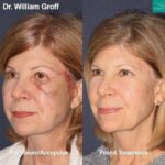 Laser Scar Removal: A Complete Guide to Treating Different Types of Scars